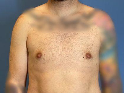 Dr. Sukkar gynecomastia after — Houston, TX
