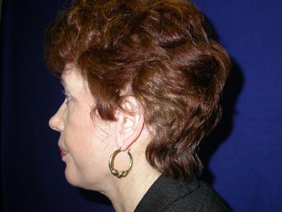 Dr. Sukkar facelift after — Houston, TX