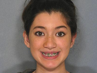 Dr. Sukkar otoplasty after — Houston, TX