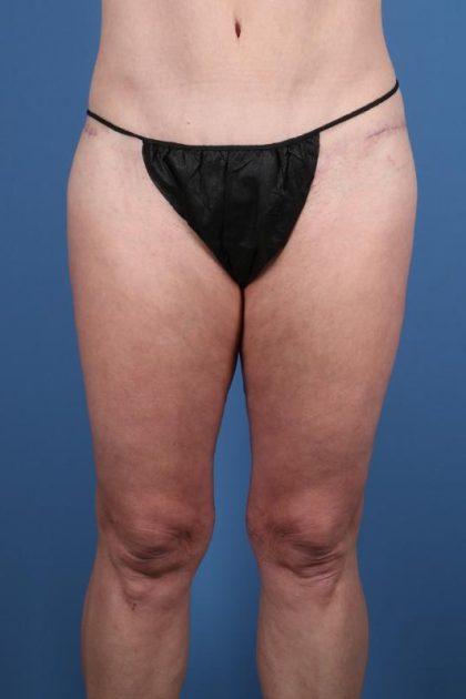 Thigh Lift after at Dr. Sukkar in Houston, TX
