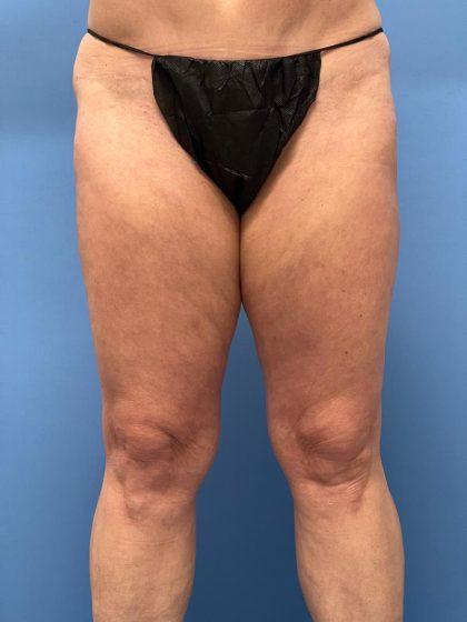 Thigh Lift before at Dr. Sukkar in Houston, TX