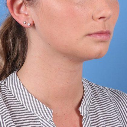 Chin Implant after at Dr. Sukkar in Houston, TX