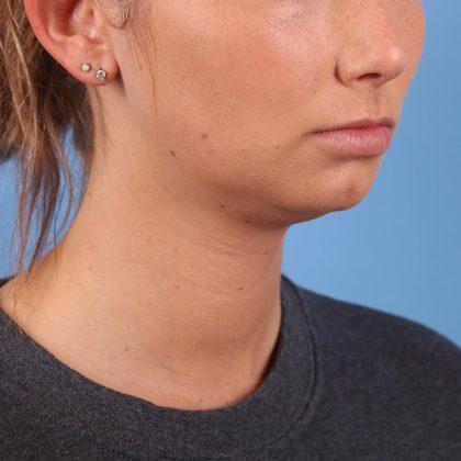 Chin Implant before at Dr. Sukkar in Houston, TX