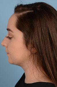 Dr. Sukkar liposuction after — Houston, TX