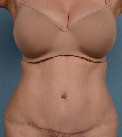 Mini Tummy Tuck after at Dr. Sukkar in Houston, TX