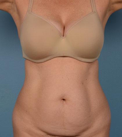 Mini Tummy Tuck before at Dr. Sukkar in Houston, TX