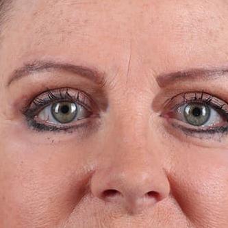 Dr. Sukkar blepharoplasty after — Houston, TX