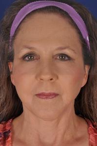 Facelift after at Dr. Sukkar in Houston, TX