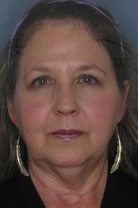 Facelift before at Dr. Sukkar in Houston, TX