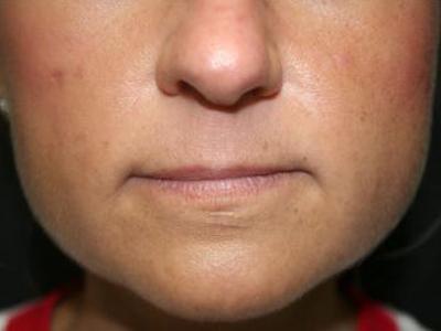 Fat Transfer after at Dr. Sukkar in Houston, TX