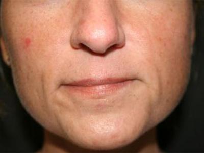 Fat Transfer before at Dr. Sukkar in Houston, TX