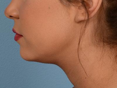 Neck Liposuction before at Dr. Sukkar in Houston, TX