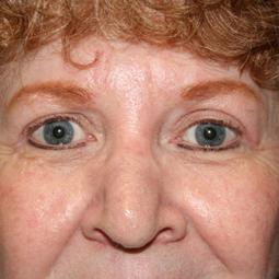 Dr. Sukkar blepharoplasty after — Houston, TX