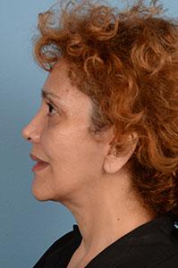 Dr. Sukkar facelift after — Houston, TX