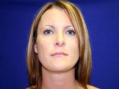 Dr. Sukkar liposuction after — Houston, TX