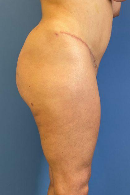 Dr. Sukkar bbl after — Houston, TX