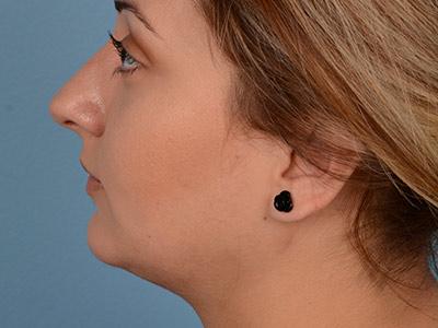 Chin Implant after at Dr. Sukkar in Houston, TX