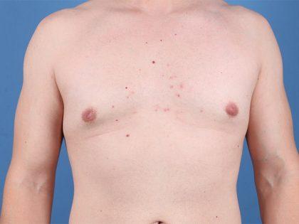 Dr. Sukkar gynecomastia after — Houston, TX