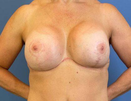 Dr. Sukkar breast augmentation after — Houston, TX