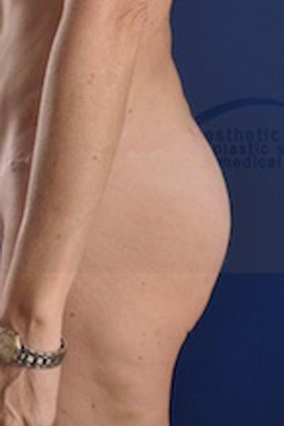Dr. Sukkar bbl after — Houston, TX