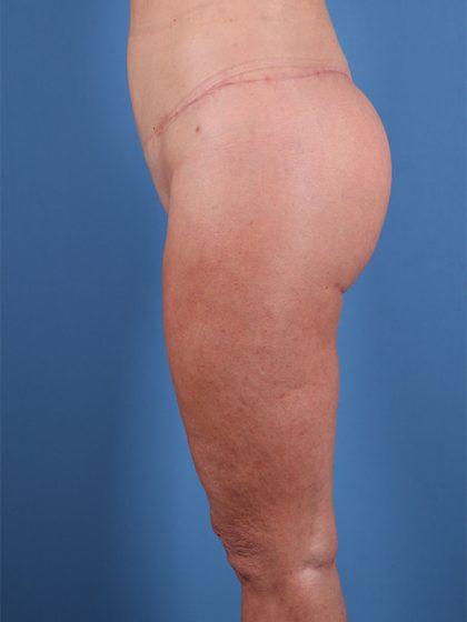 Dr. Sukkar bbl after — Houston, TX