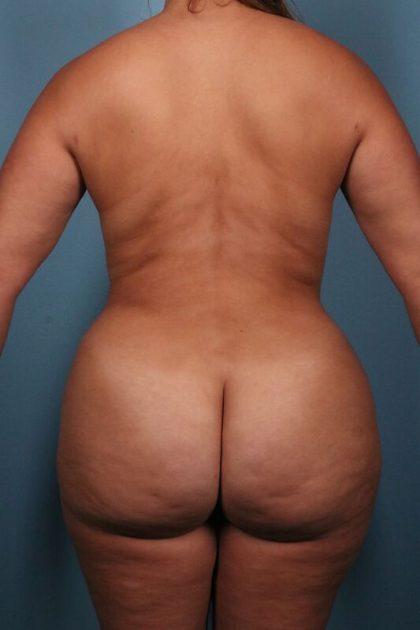 Brazilian Butt Lift after at Dr. Sukkar in Houston, TX