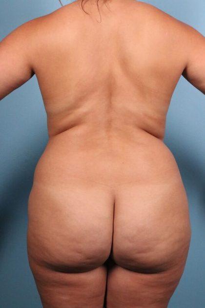 Brazilian Butt Lift before at Dr. Sukkar in Houston, TX