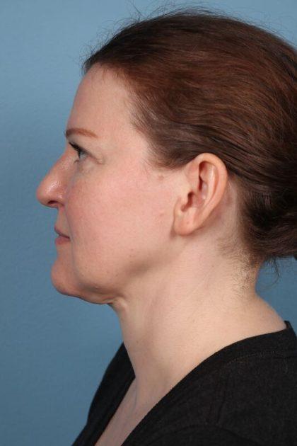 Dr. Sukkar facelift after — Houston, TX