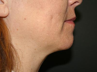 Dr. Sukkar liposuction after — Houston, TX