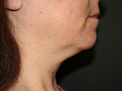 Neck Liposuction before at Dr. Sukkar in Houston, TX