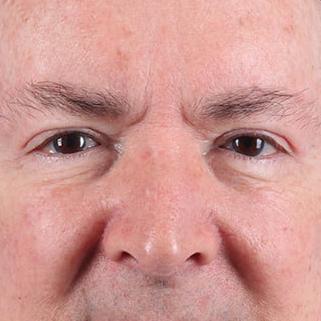 Dr. Sukkar blepharoplasty after — Houston, TX