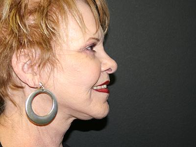 Facelift after at Dr. Sukkar in Houston, TX