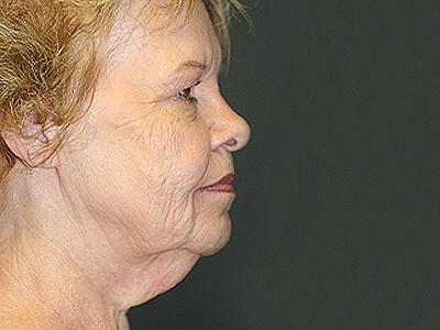 Facelift before at Dr. Sukkar in Houston, TX