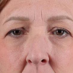 Dr. Sukkar blepharoplasty after — Houston, TX