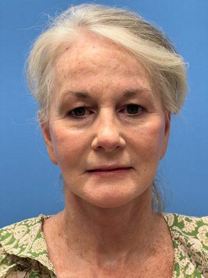 Dr. Sukkar facelift after — Houston, TX