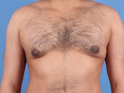 Dr. Sukkar gynecomastia after — Houston, TX