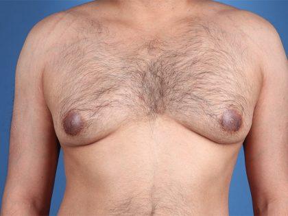 Gynecomastia Surgery before at Dr. Sukkar in Houston, TX