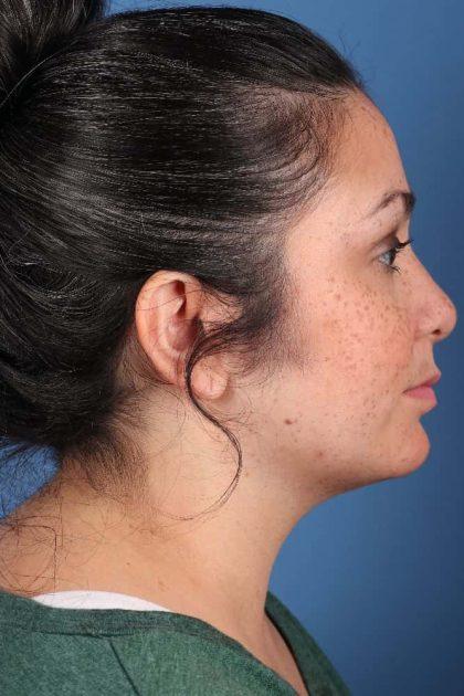 Dr. Sukkar liposuction after — Houston, TX