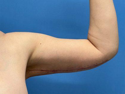 Arm Lift after at Dr. Sukkar in Houston, TX