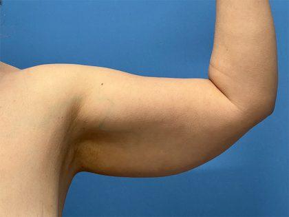 Arm Lift before at Dr. Sukkar in Houston, TX