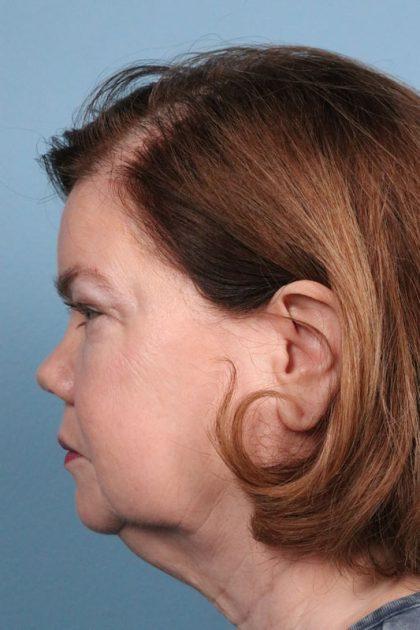 Brow Lift before at Dr. Sukkar in Houston, TX