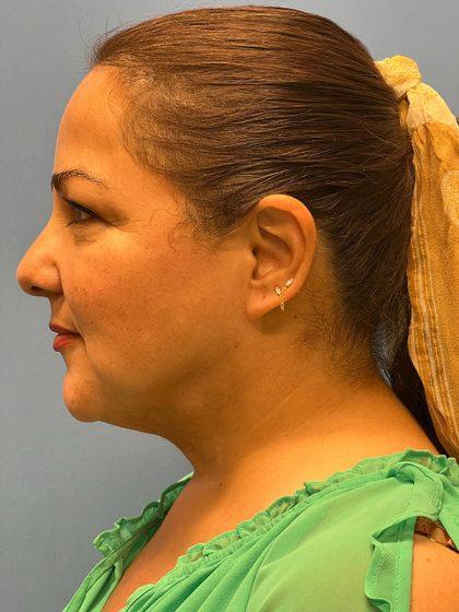 Neck Liposuction after at Dr. Sukkar in Houston, TX