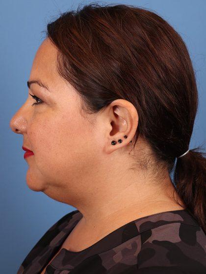 Neck Liposuction before at Dr. Sukkar in Houston, TX