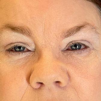 Dr. Sukkar blepharoplasty after — Houston, TX