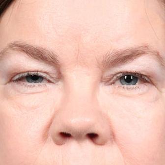 Blepharoplasty before at Dr. Sukkar in Houston, TX