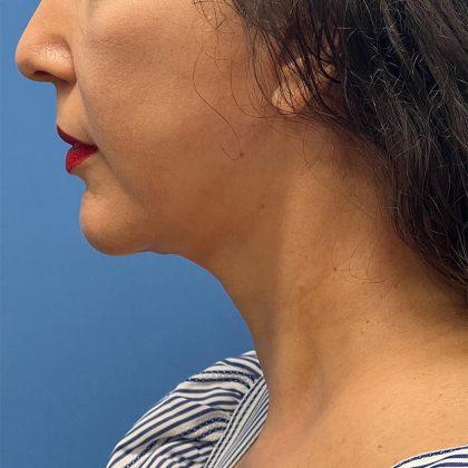 Dr. Sukkar facelift after — Houston, TX