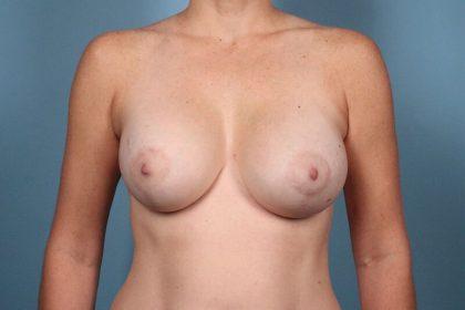 Dr. Sukkar breast augmentation after — Houston, TX