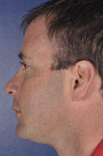 Chin Implant after at Dr. Sukkar in Houston, TX