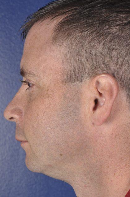 Chin Implant before at Dr. Sukkar in Houston, TX
