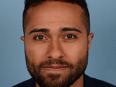 Dr. Sukkar otoplasty after — Houston, TX